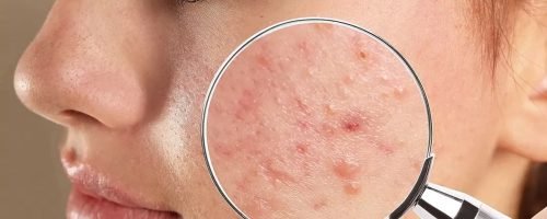 How to Get Rid of Pimples Overnight