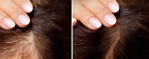 reduce thin hair and get best hair weight and texture